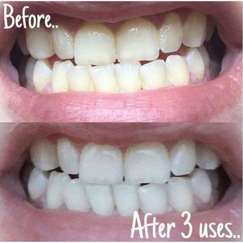 Teeth Whitening Toothpaste ????.